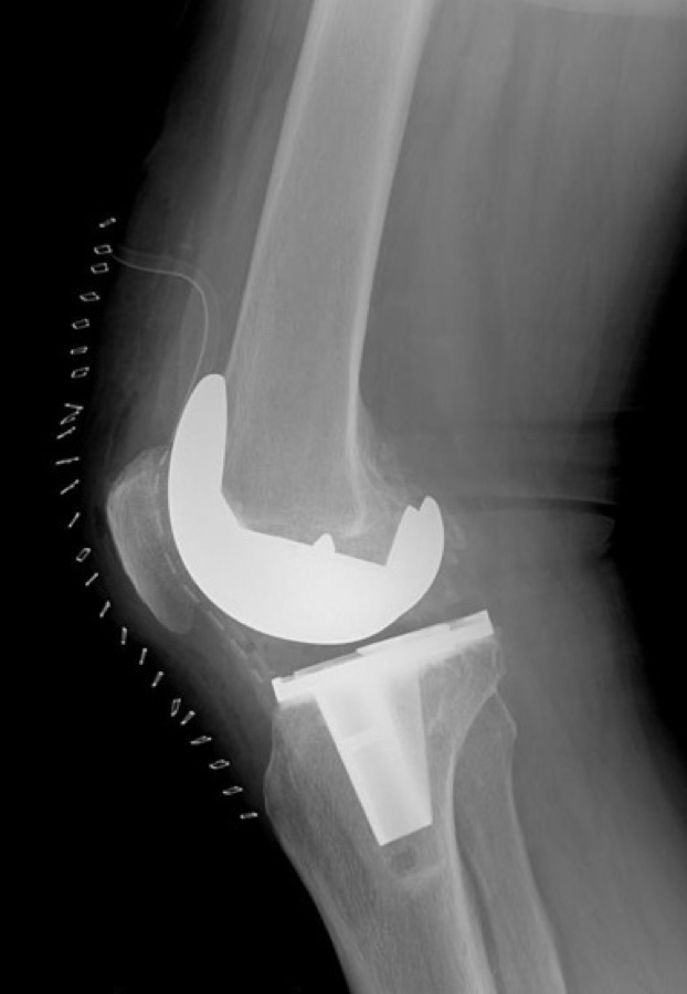 Radiografie laterală a unui genunchi protezat
